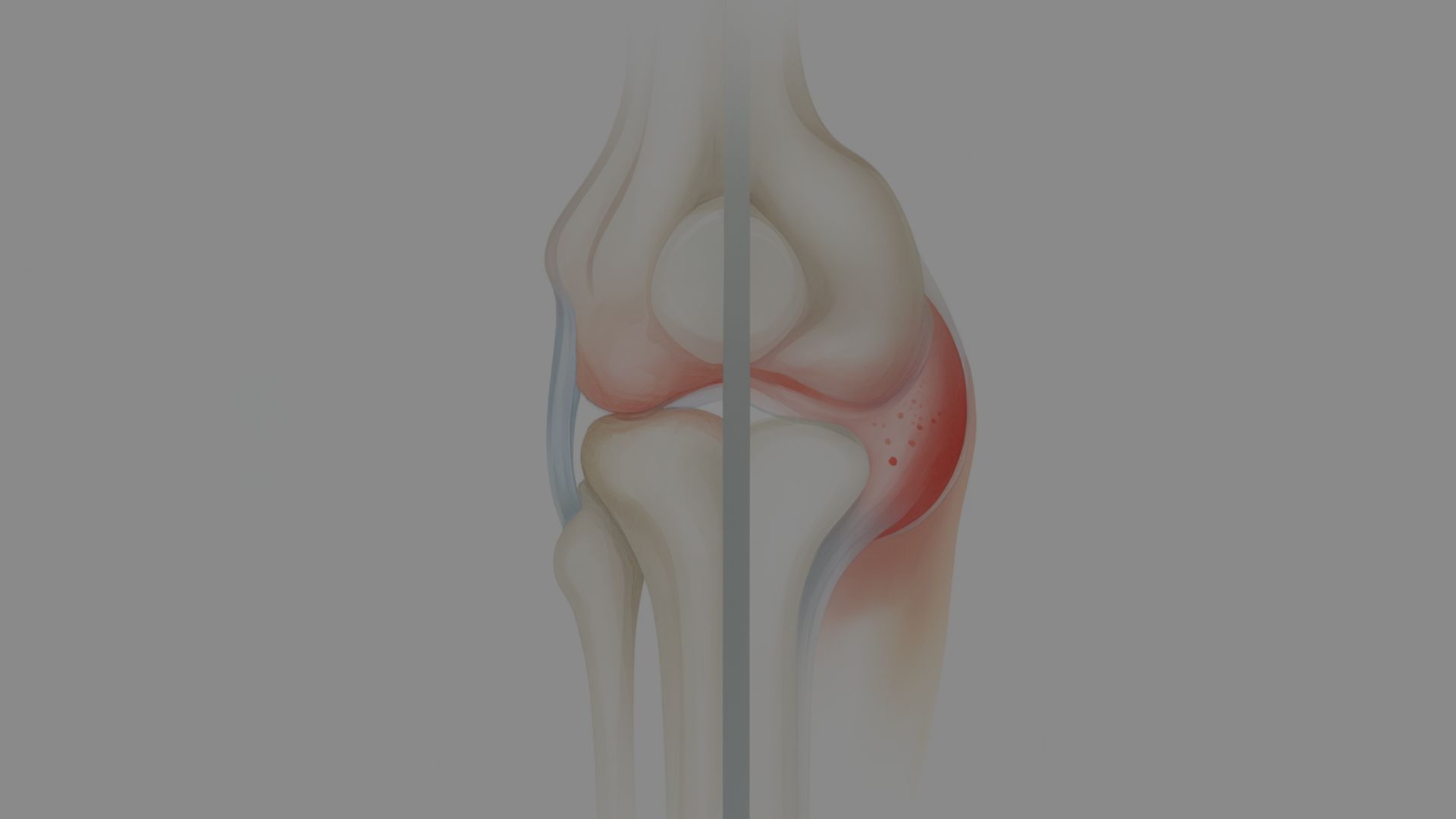 arthrite