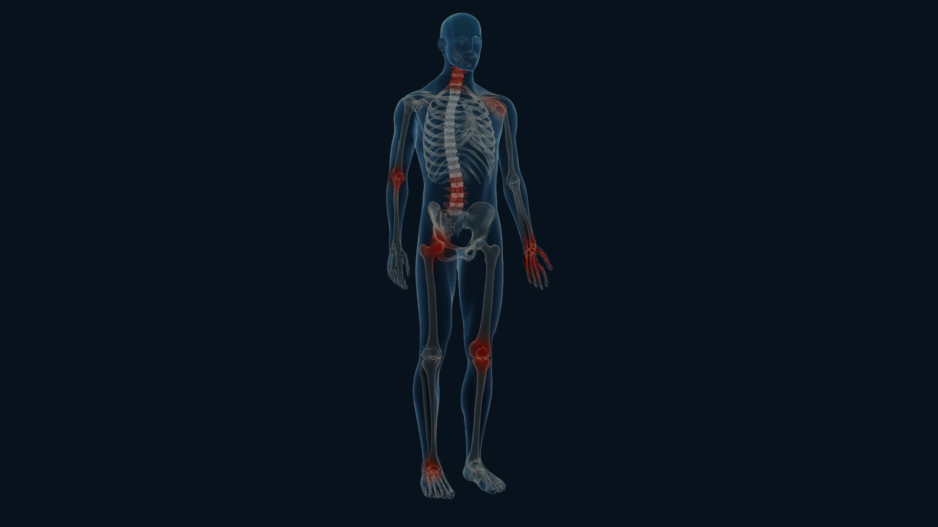 arthrose signes