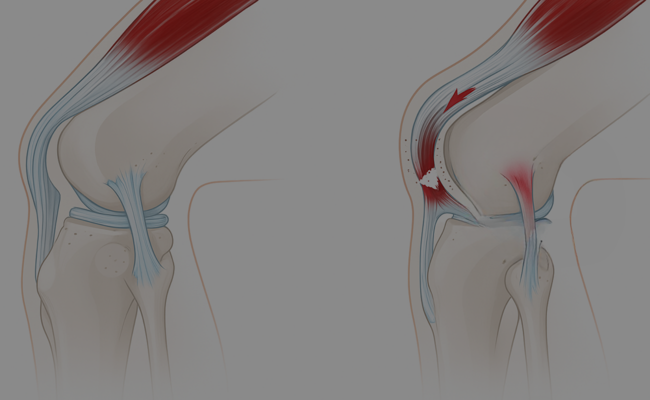 déchirures musculaires