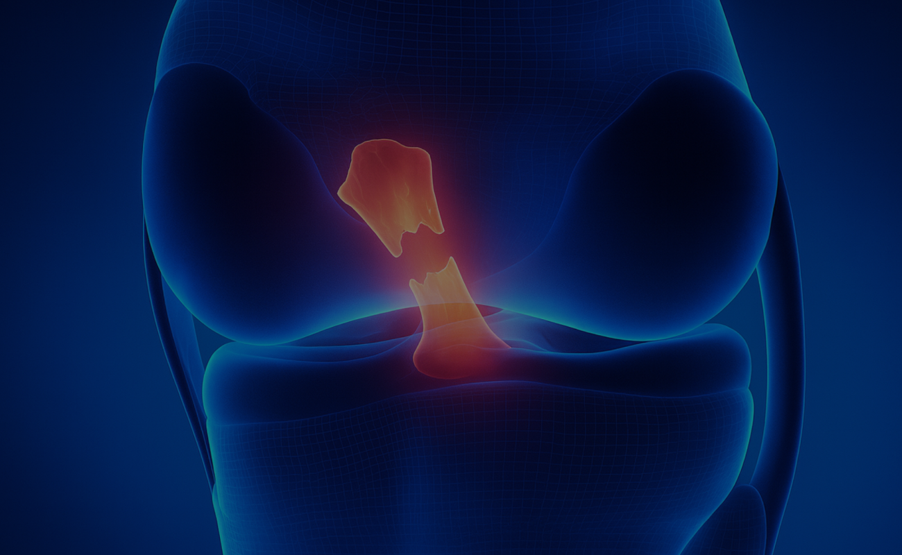 ligament croisé chirurgie